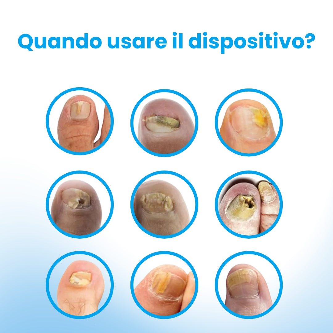 NailRepair Pro™ – Dispositivo Trattamento Laser Micosi delle Unghie