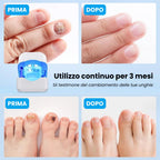 NailRepair Pro™ – Dispositivo Trattamento Laser Micosi delle Unghie